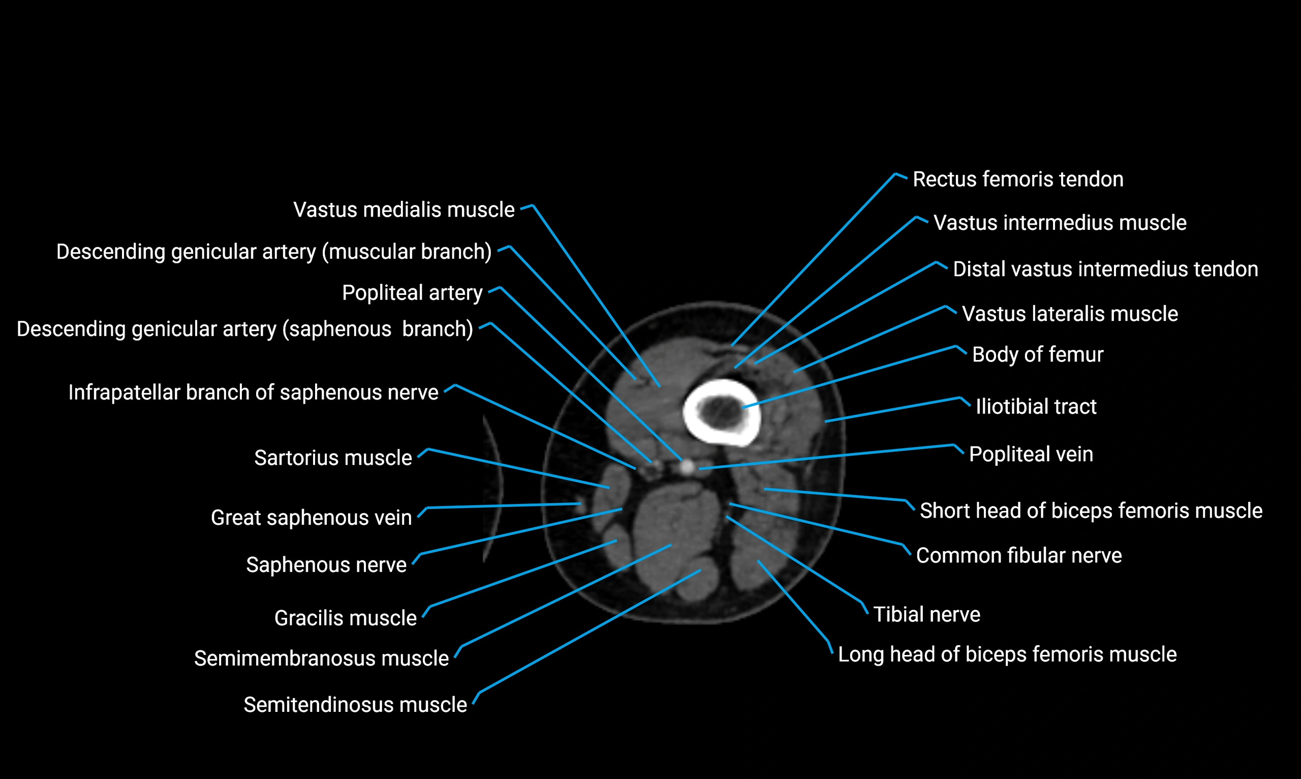 CT lower limb axial cross sectional anatomy labelled image 68 (2).webp